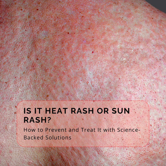 Heat rash sun rash prickly heat photodermatitis polymorphous light eruption PMLE lupus skin rash summer skincare vegan skincare Intensive Skin Recovery Cream sensitive skin eczema psoriasis hormonal acne mineral sunscreen UV protection