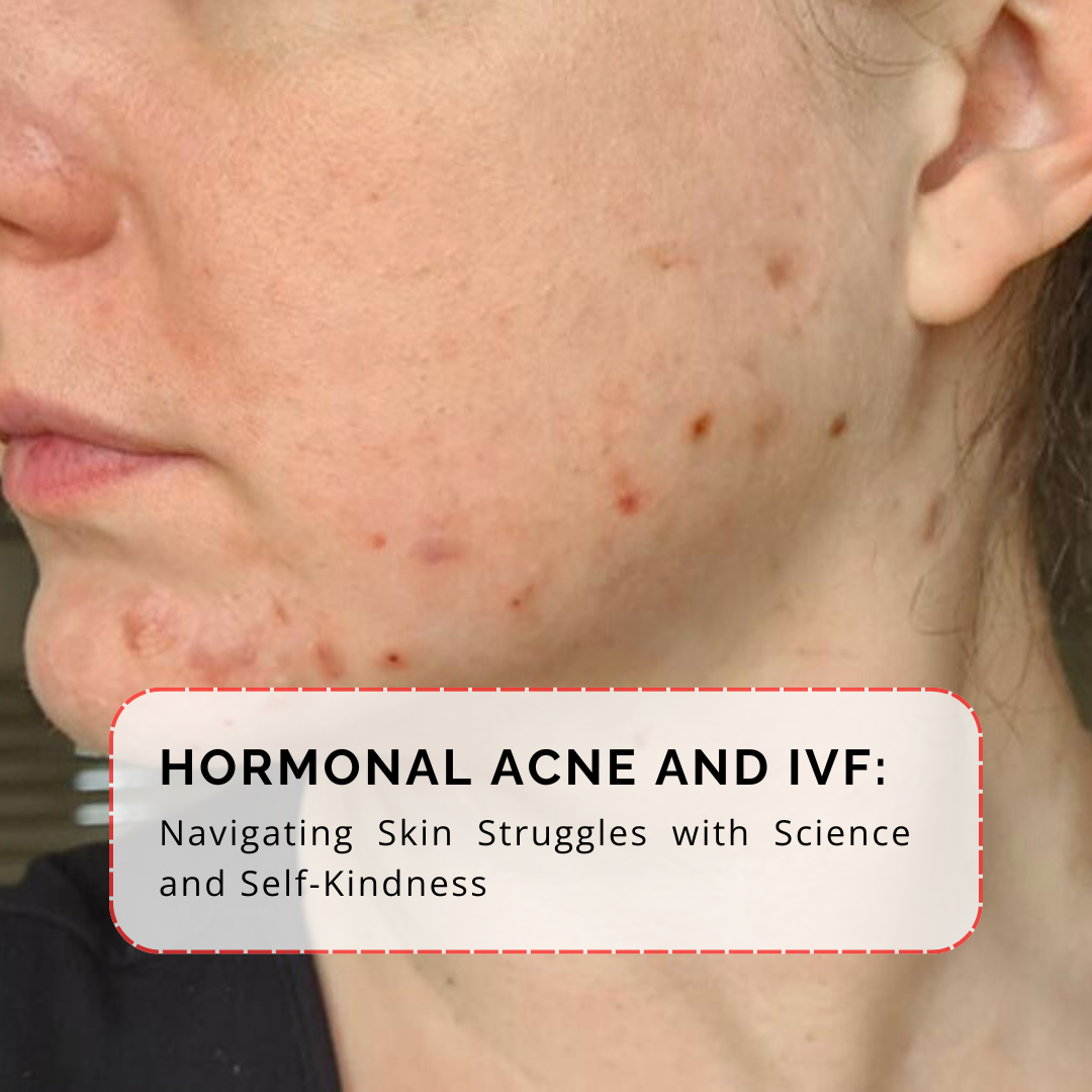 Ivf acne hormonal