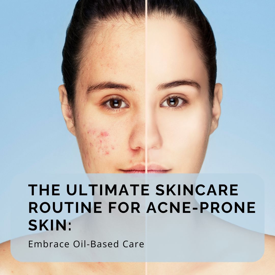 The Ultimate Skincare Routine for Acne-Prone Skin: Embrace Oil-Based Care - Obvs Skincare