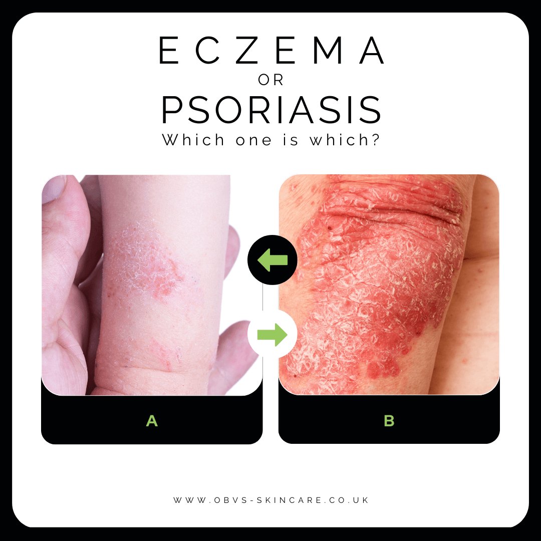 Differences between Eczema and Psoriasis - Obvs Skincare