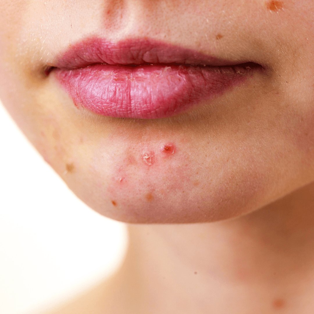 Is Dairy Giving Me Acne? - Obvs Skincare