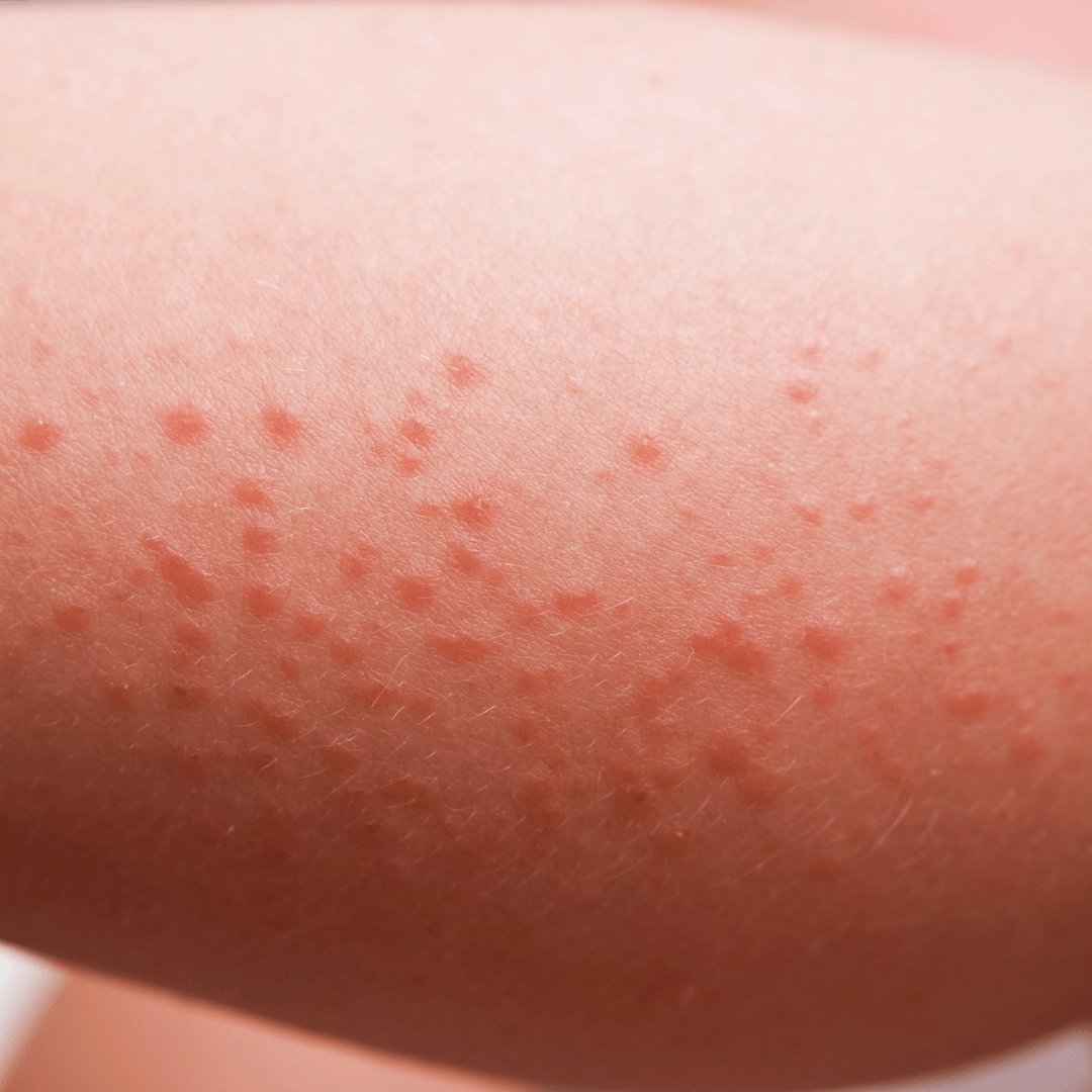 Is It Heat Rash Or Sun Rash and How To Prevent/Treat It. - Obvs Skincare