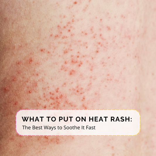 For SEO and accessibility, I’d keep it descriptive and natural:  **Alt text:** `Heat rash and sun rash causing red, irritated skin after sun exposure`
