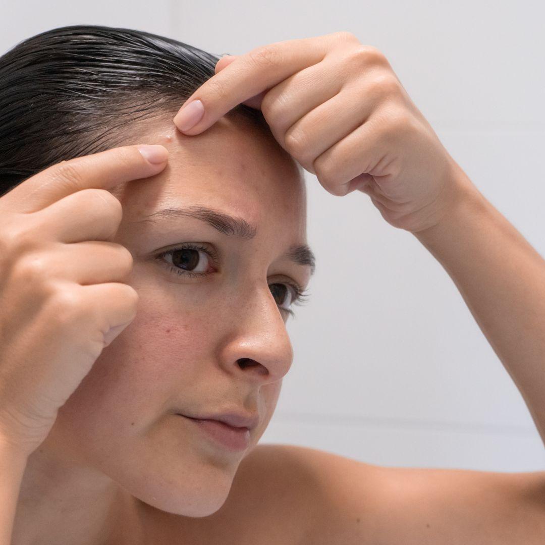 Stop Zapping Your Zits! 5 Ways to Get Rid of Pimples - Guest Blog by Katie Pierce - Obvs Skincare