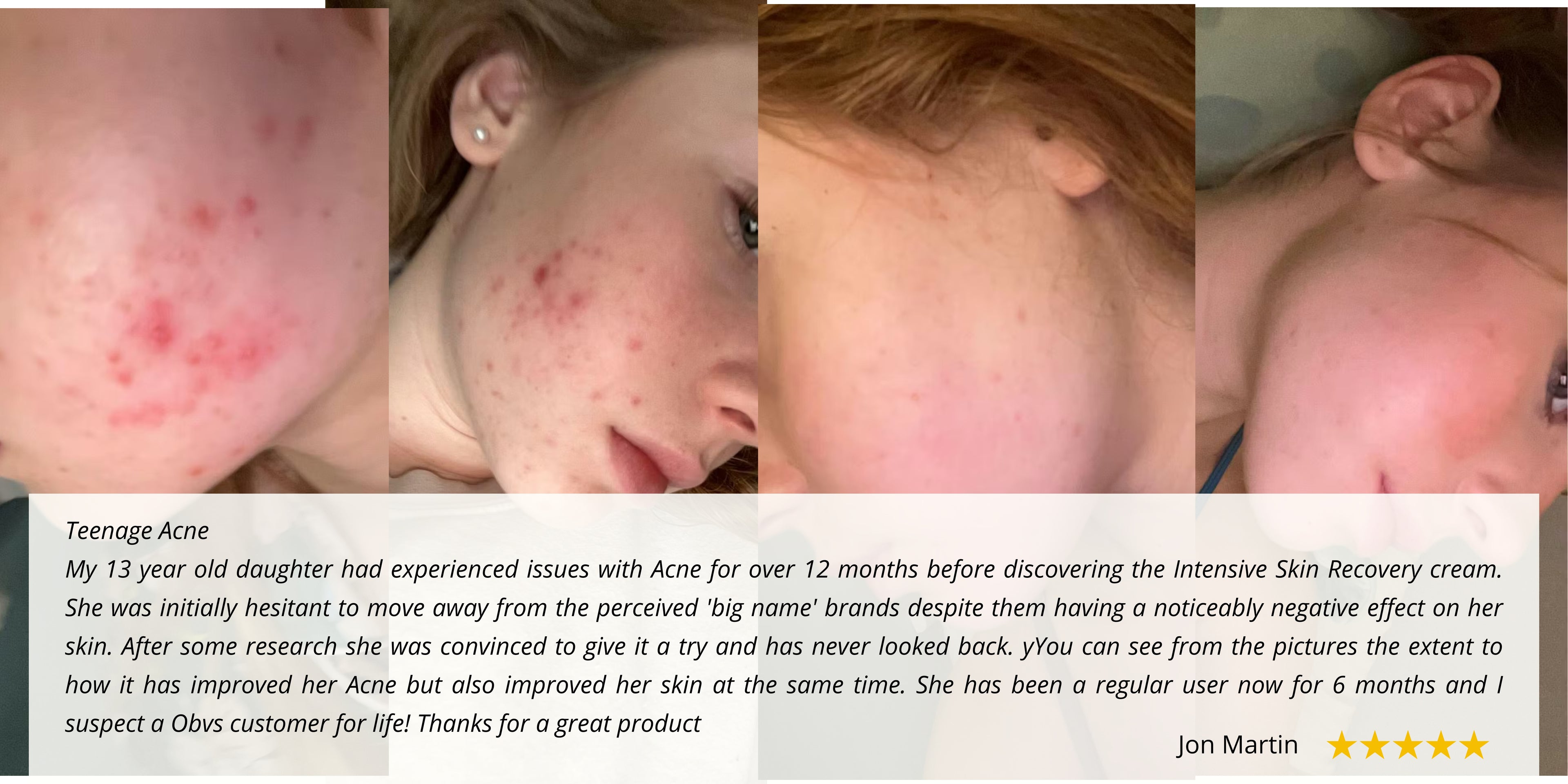 Side-by-side comparison of a teenager's cheek before and after using Obvs Skincare. The left shows red, inflamed acne breakouts; the right shows significantly clearer, calmer skin with reduced redness.